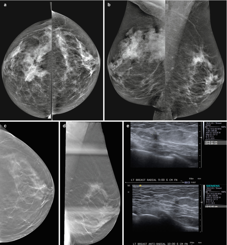 Breast Cancer Mammogram